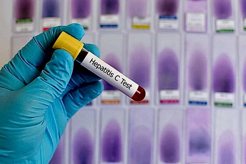 Anti HCV